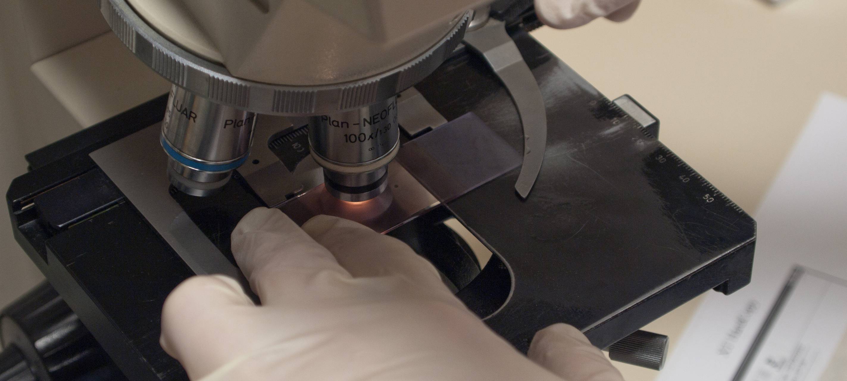 Essen: Zweiter Fall von Affenpocken bestätigt