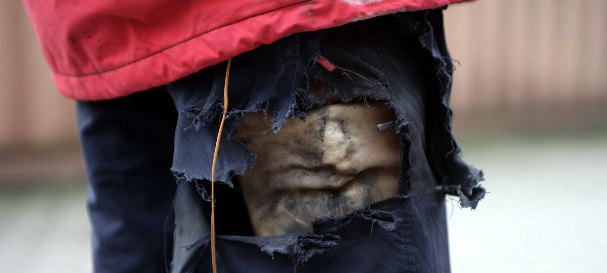 Explosion eines Böllers in der Hosentasche einer Puppe