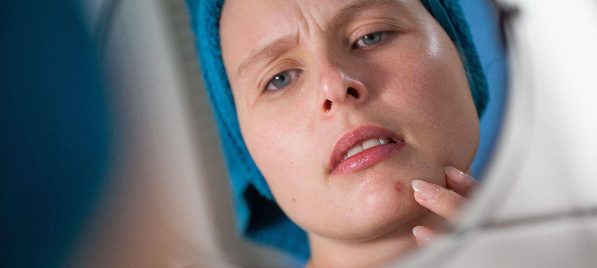 Frau betrachtet einen Pickel im Spiegel